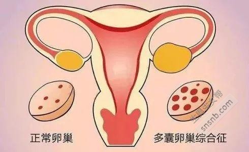 [多囊卵巢受孕的最快方法]什么是多囊卵巢综合症？