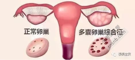 ＂多囊卵巢 ＂试管婴儿前如何调整自己的身体？